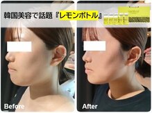 カルナ(CARNA)の雰囲気（韓国美容で話題のレモンボトルはダウンタイム・リバウンドなし！）