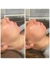 ［韓国最新痩身マシン］切らずに脂肪減少！オンダリフト★頬のみ