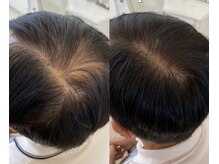 カナエル ビューティーサロン(Canael Beauty salon)/プロセルセラピーズ　2回