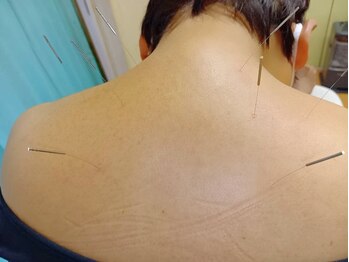 上田鍼灸治療院/○肩こり・頭痛でお悩み○
