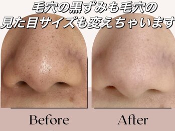 メディカルサロン ファン(FUN)の写真/すっぴんに自信◎ノーファンデに近づく♪角栓・産毛・毛穴汚れをまとめてケアする毛穴リメイクで美肌革命!