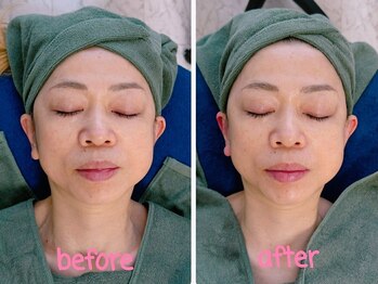 アコベル(Ako-Bell)の写真/【溝の口駅・高津駅】当店自慢のFace Slimmingで小顔とたるみケア◎実年齢よりも若々しいお顔立ちへ♪