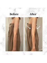 ザビューティー 麻布十番本店(The Beauty)/二の腕リフト打ち放題[リフト]