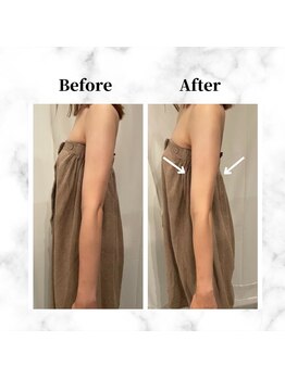 ザビューティー 麻布十番本店(The Beauty)/二の腕リフト打ち放題[リフト]