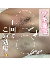 サロン(SALON)/メンズ脱毛：ワキ