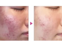 フルール/乳酸ピーリング