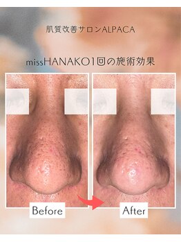 アルパカ(ALPACA)/missHANAKO