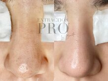 一度の施術でここまで変わる大満足の毛穴エクストラクションプロ