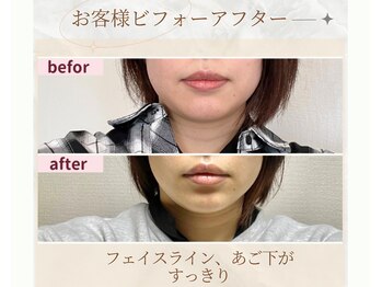 プランドール/フェイスラインがＶ字にすっきり