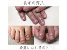 ティアラネイル 宇都宮/深爪矯正
