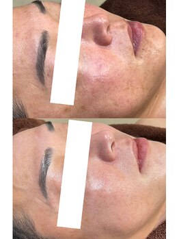 ウェリナベル(WelinaBelle)/ダクトピール：再生型ピーリング