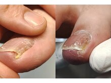 フルフィル 北千住/巻き爪　Befre　After