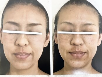 ダルセーニョ/コルギ施術１回目　Before-After