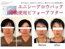 セラピエージ/エニシー連続使用チャレンジ！