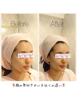 アンジェリカ(Angelica)/リフトアップした整ったお顔に！