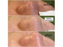 メディカル サンテロッソ(MEDICAL SANTEROSSO)の雰囲気（特殊スチームパックで毛穴の奥底からしっかり汚れを浮き出す）