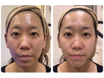 リモレア(RemoLe'a)/美顔筋テラボーラー