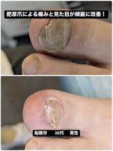 巻き爪じゅん 千葉駅前店/肥厚爪の痛み見た目が改善