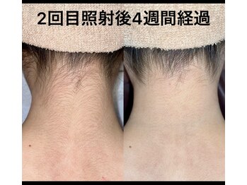 ルイース(LOUISE.)/脱毛