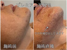 MMAの雰囲気(当店の光脱毛はレーザーと同じ仕組み!何十回も通う必要なし!)