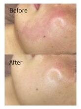 毛穴/シミ/フェイシャル/ララピール【錦糸町ビューティークリニック】美容医療提携/ララピール/毛穴/フェイシャル