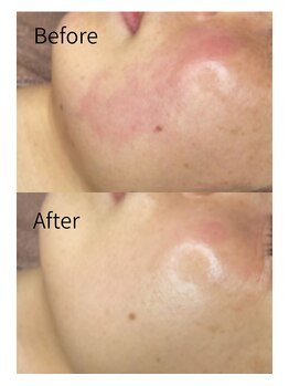 毛穴/シミ/フェイシャル/ララピール【錦糸町ビューティークリニック】美容医療提携/ララピール/毛穴/フェイシャル