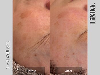 リノアドット(LiNOA.)/シミ・シワでお悩みの方