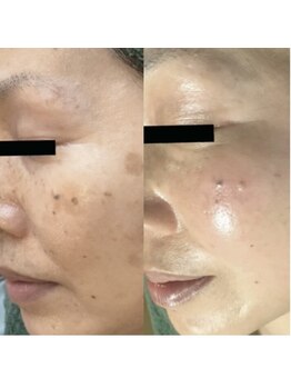 ホワイトアクア 梅田本店(WHITE AQUA)/ハーブピーリング/大阪/梅田