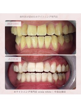 エクシアホワイトニング 札幌中島公園店/Before After［ホワイトニング］