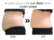 プレジール(plaisir)/ぽっこり解消