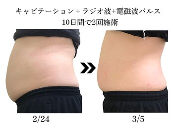 プレジール(plaisir)/ぽっこり解消