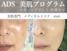 【ADS肌改善プログラム】お試し＆カウンセリング