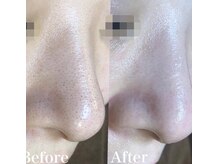 チュチュ(TUTU)/毛穴洗浄×ハーブトリートメント