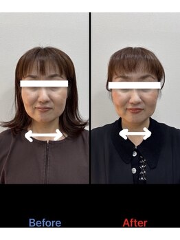 ラムーン(La.Moon)/小顔・美容鍼×フェイシャル