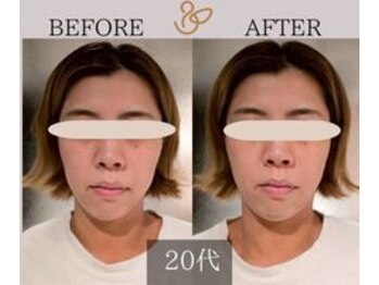 チョコバリ 新宿店(chocobari)/小顔×リフトアップ(美容鍼)20代