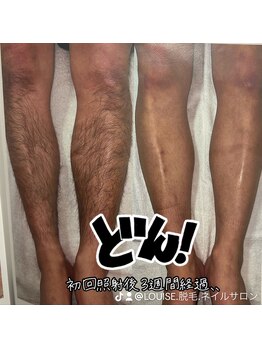 ルイース(LOUISE.)/脱毛