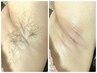 脇毛ダブル脱毛 2回セット