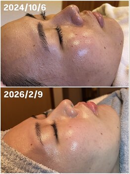 アリス(Alice)/マツヤニWAX Before After