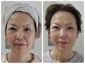 ティアス(t-us)/【真皮】水光肌ACトリートメント