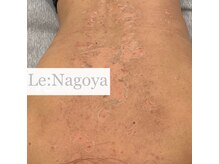 リベル 名古屋(Lebelle:)/ハーブピーリング専門名古屋