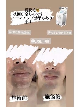 イースヘアーアンドビューティーショップ(ease hair&beauty shop)/美肌+髭脱毛
