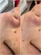 ミュレア 新宿本店(mulea)/【ハイドラ＋ポレーション】