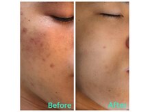 プレシャス(precious)の雰囲気(素肌改善!サロン&ホームケアでニキビケア◎トーンアップ効果も)