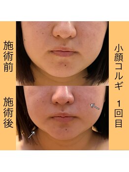 オプレア 栄店(OPREA)/比較写真【小顔コルギ】