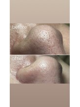 エピシアドットエヌ(epicia.N)/頑固な角栓除去！！