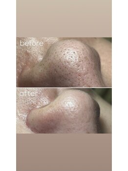 エピシアドットエヌ(epicia.N)/頑固な角栓除去!!