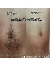 ルイース(LOUISE.)/脱毛