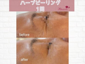 ブランリス(Blanclis)/REVIハーブ　ビフォーアフター