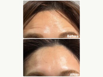 アンフェム(Anfem)/水光ボツリヌスフェイシャル