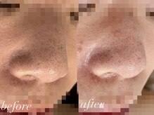 ビューティーサロン プティ(beauty salon petite)/毛穴ケア・ハーブ/施術5回